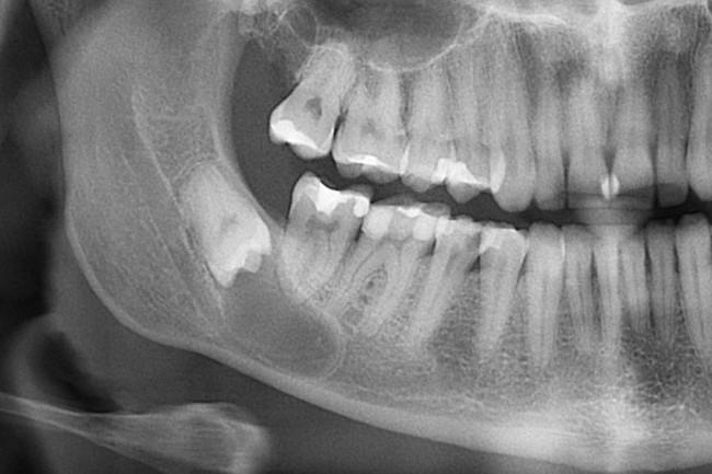 Как происходит сложное удаление зуба мудрости, когда процедуру проводит профессионал