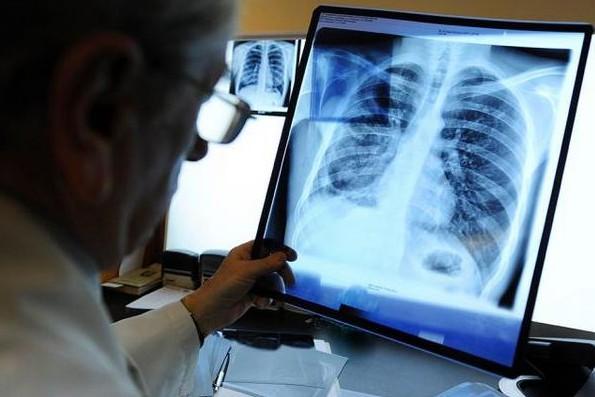 Захворюваність на туберкульоз у Ніжині зросла майже вдвічі