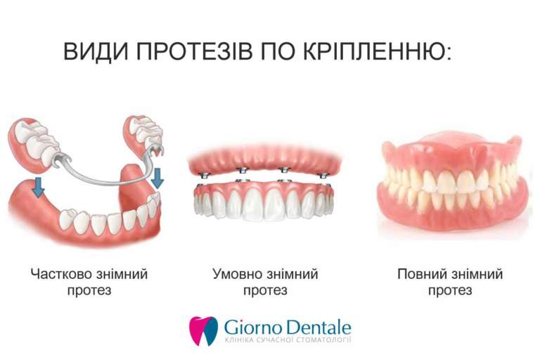 Види зубних протезів і які краще обрати?