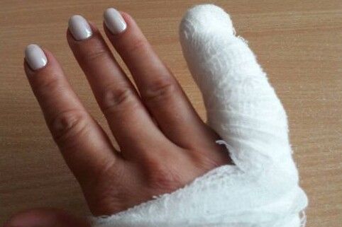 Житель Прилук зламав палець знайомій і постане перед судом