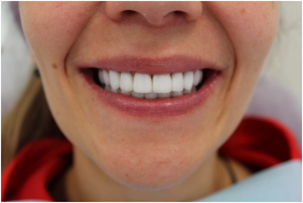 Протезування зубів види, ціни та нові технології при повній відсутності зубів