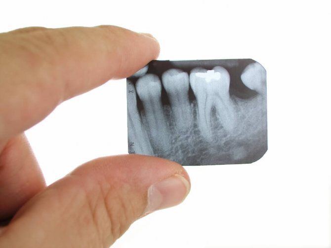 Зачем делать рентгеновский снимок зуба?