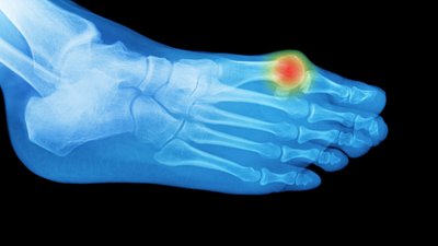 Кісточки на пальцях ніг: чому вони з’являються та чи можна їх позбутися