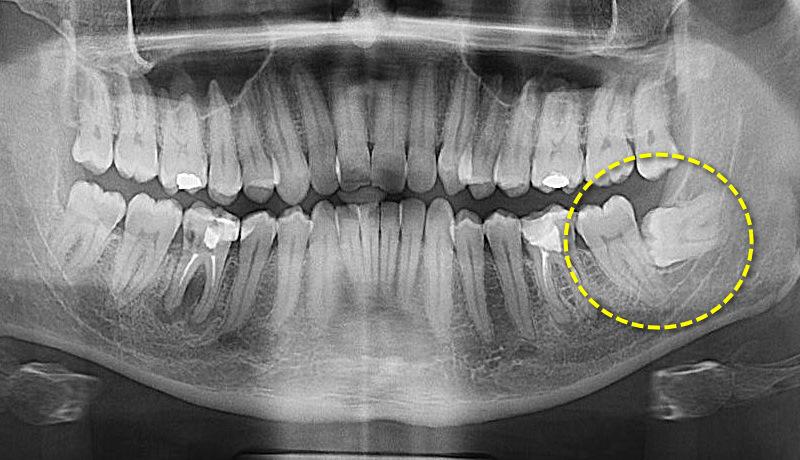 Чи може стоматолог-хірург запропонувати щось окрім видалення зубів?