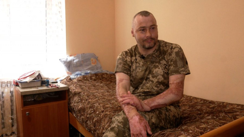 "Зняли бинти — і почав вишивати": як боєць із Чернігівщини, який має 36% опіків тіла, відновлюється після поранення