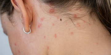 На Чернігівщині у 2025 році зросла кількість випадків корости, майже половина хворих — діти