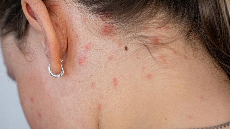 На Чернігівщині у 2025 році зросла кількість випадків корости, майже половина хворих — діти