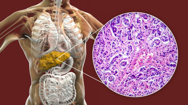 Чому молодшає інсульт та як ШІ допомагає неврологам Чернігівщини